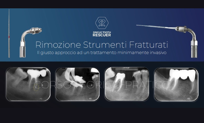 Rimozione elementi fratturati sito